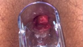 Speculum Anal Vision
