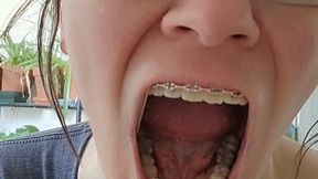Braces and Spitting