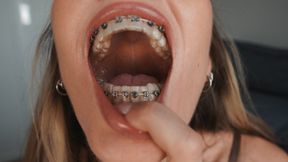 Try On: Clear Retainers with Metal Brackets