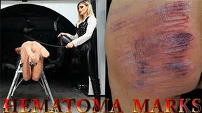 HEMATOMA MARKS mobile version