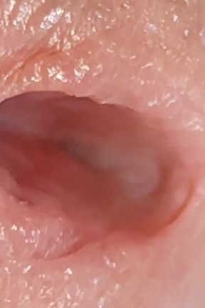 Enlargement of the Deep Urethral Hole!!