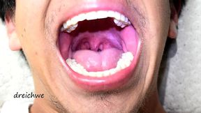 deep uvula