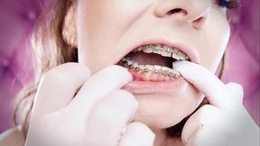 ASMR: upgraded braces with chain-link rubber bands and nitrile gloves