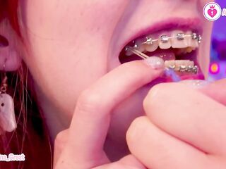 SFW Braces Elastics Close-Up