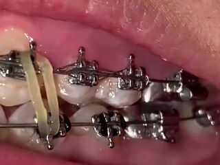 Mira que tanto metal tengo en mi boca ????