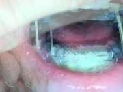 Self facial cumming on braces retainer twinblock with headgear