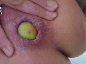 Anal dilation with 2 apples at home...