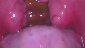 Gummy Bear Swallow ENDOSCOPE