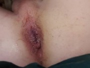 solo anal dilatation