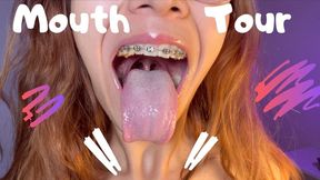 Braces Mouth Tour