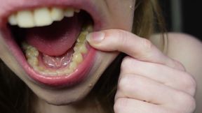 I Tell You About the Fillings in My Teeth and Dental Visits