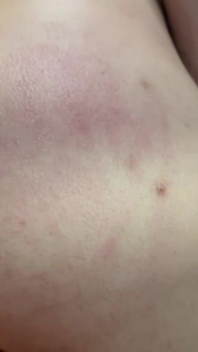 Not Blistered or Bruised yet