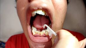Using dental floss after eating (close-up) dirty teeth. Cleaning dirty teeth. Swollen gums.