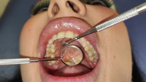 Complete Teeth Exam by the Dentist, Installation of Jewelry