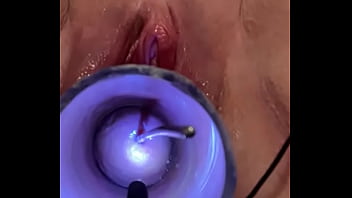 Inserting sound into cervix