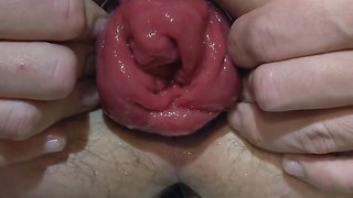 Strengthening my anal prolapse