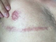 FtM Chest Scar Massage