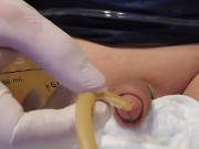 removal 20Fr Catheter