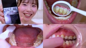 Yuzu Fujita - Observing Yuzu's teeth with a dental mirror & brushing her teeth while wearing a mouth opener & finger toothbrushing while wearing a lip hook - 1080p