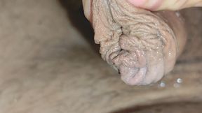 Detaching the Foreskin From the Glans Slowly.