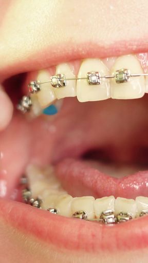 Iconic moment from "eating in braces - vore and food fetish - close up video"