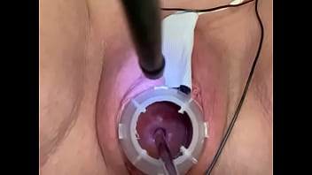 Painful electrosounding cervix