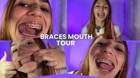 Braces Mouth Tour 2