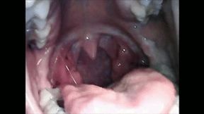 Endoscopic belching