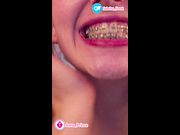 SFW New Braces After Adjustment vertical