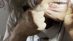 Close up of my oral fistula and smoking