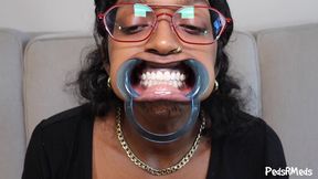 Youronlyphoenix Dental Retractor Mouth Tour