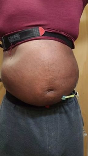 N2O belly inflation