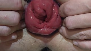 Pumping anal prolapse