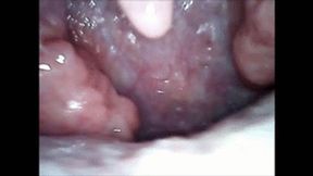 Hiccups endoscopy wmv