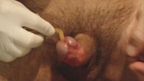 Foley catheter CH 20 - insertion and play.AVI