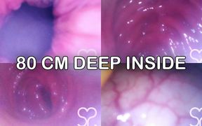 Anal Endoscope All the Way in My Transverse Colon!