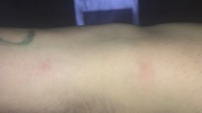VAMPIRE BIT