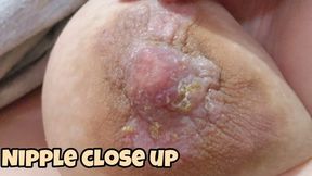 Close-Up Nipple Examination Showing My Peeling Skin Problem to the Doctor with Detailed View of My Breasts