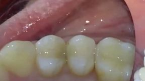 Total reconstruction of two lower molars with composite 4K
