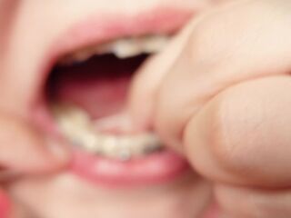 My 2nd day in braces: cleaning by dental floss