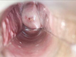climax speculum