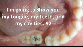 I'm going to show you my tongue, my teeth, and my cavities. #2