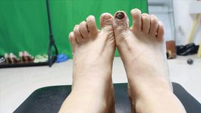 ERER Onychomycosis HD
