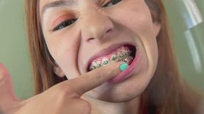 Braces close up copy