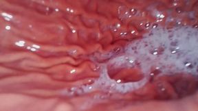 Carolyn: Throat to Gut (ENDOSCOPIC FOOTAGE)