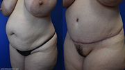 Mature Milf Gets Tummy Tuck