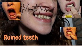 Tour mouth, ruined teeth
