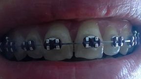 My teeth with braces mp4