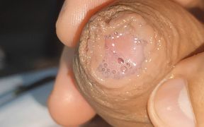 Curious Close-up of Pre-cum in Flaccid Phimosis.