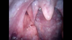 Endoscopy compilation wmv
